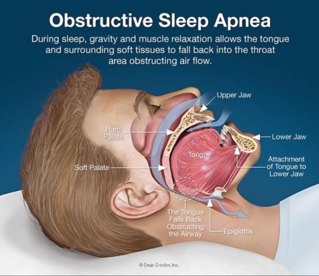 What is Sleep Apnea? - Dr. Ismail