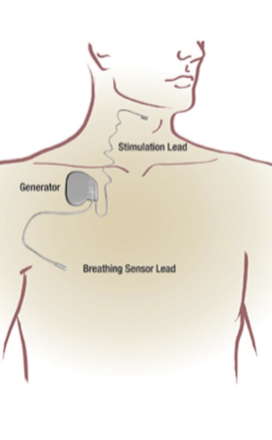 Alternatives to CPAP Therapy - Dr. Ismail